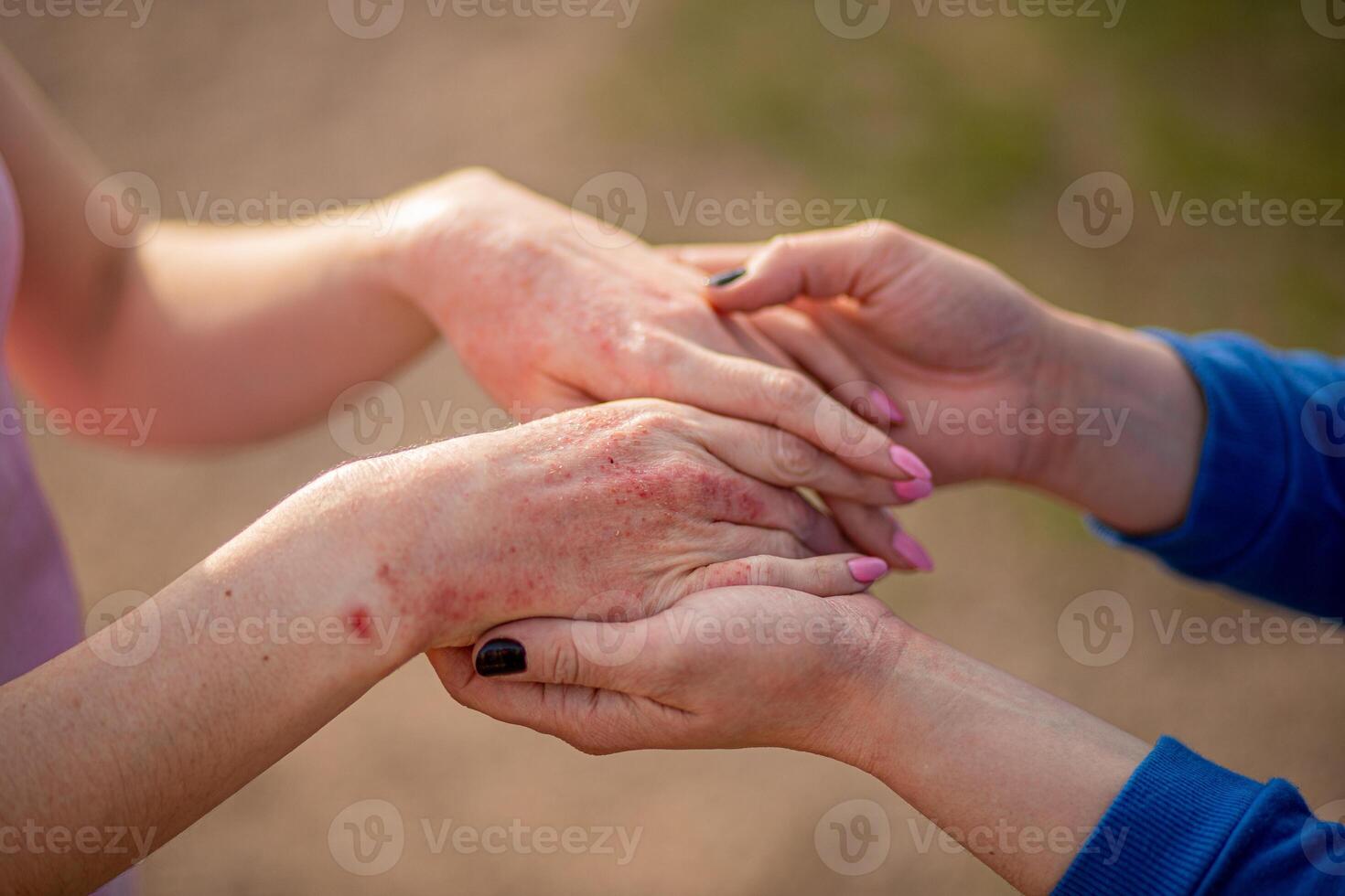 Close up dermatitis on skin, ill allergic rash eczema skin of patient , atopic dermatitis symptom skin detail texture , Fungus of skin ,The concept dermatology, treatment fungal photo