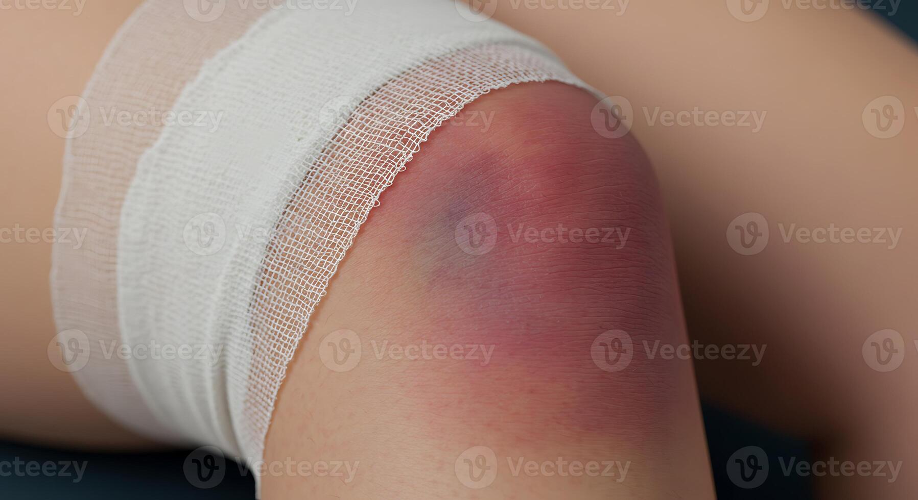 Knee Bruise Bandaged Medical Condition Injured Leg Healthcare Image photo