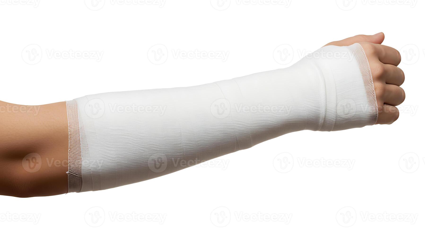 Arm Cast Immobilization Therapy for Fracture Recovery and Medical Treatment photo