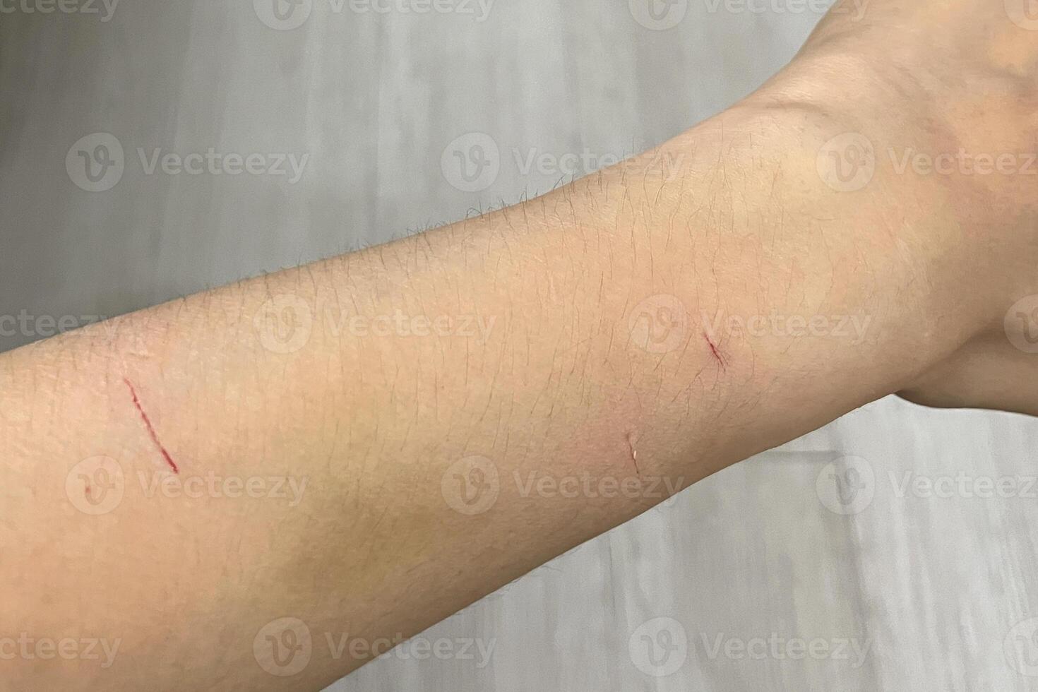 cat scratch wounds on human hand. cat scratches that cause on chest wound photo