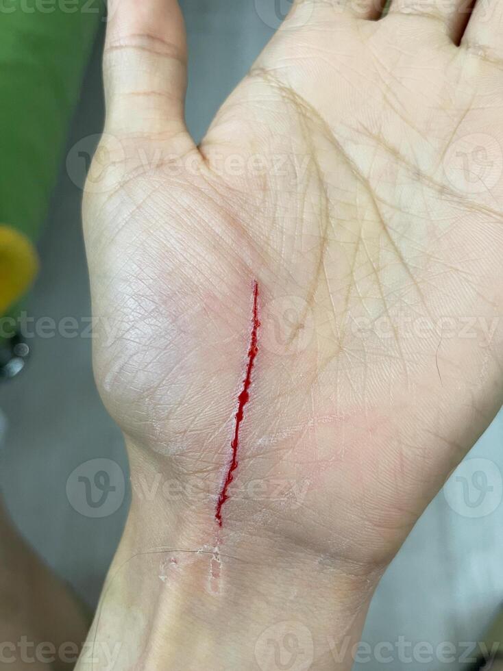 cats scratch wounds on human hand. cat scratches that cause on chest wounds photo