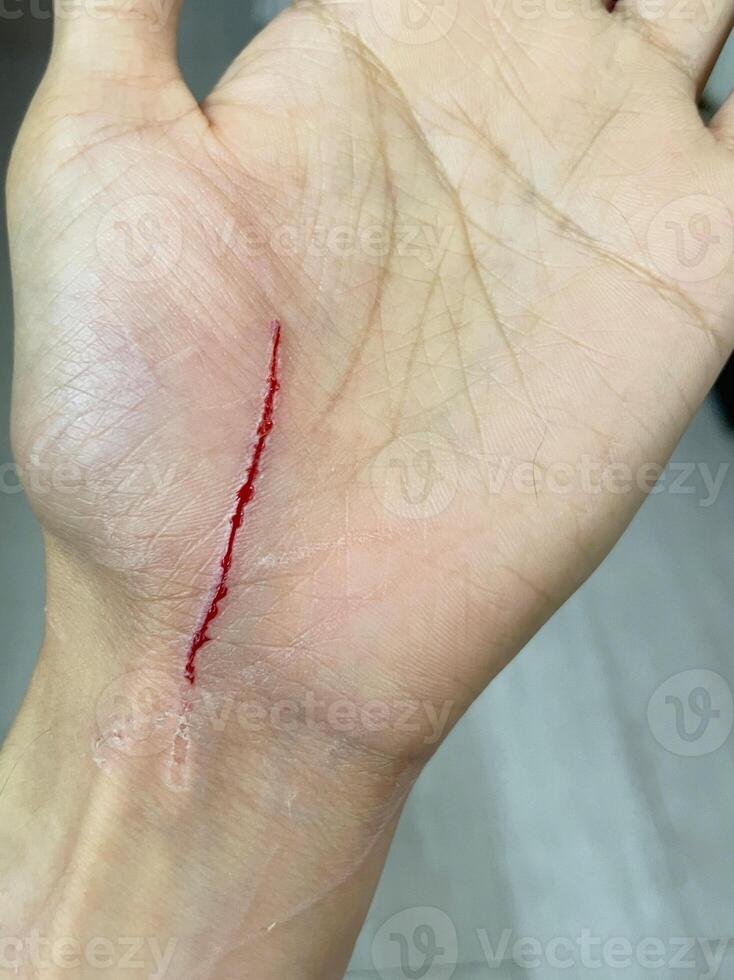 cat scratch wound on human hand. cat scratches that cause on chest wounds photo
