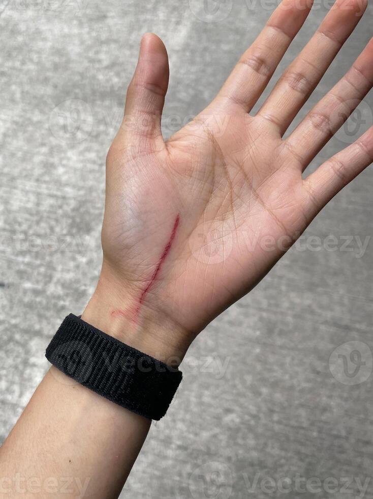 cat scratch wounds on human hand. cat scratches that cause on chest wounds photo