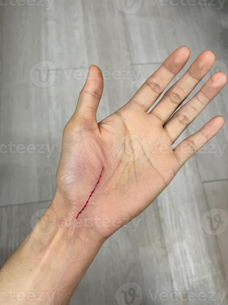 a cat scratch wounds on human hand. cat scratches that cause on chest wounds photo