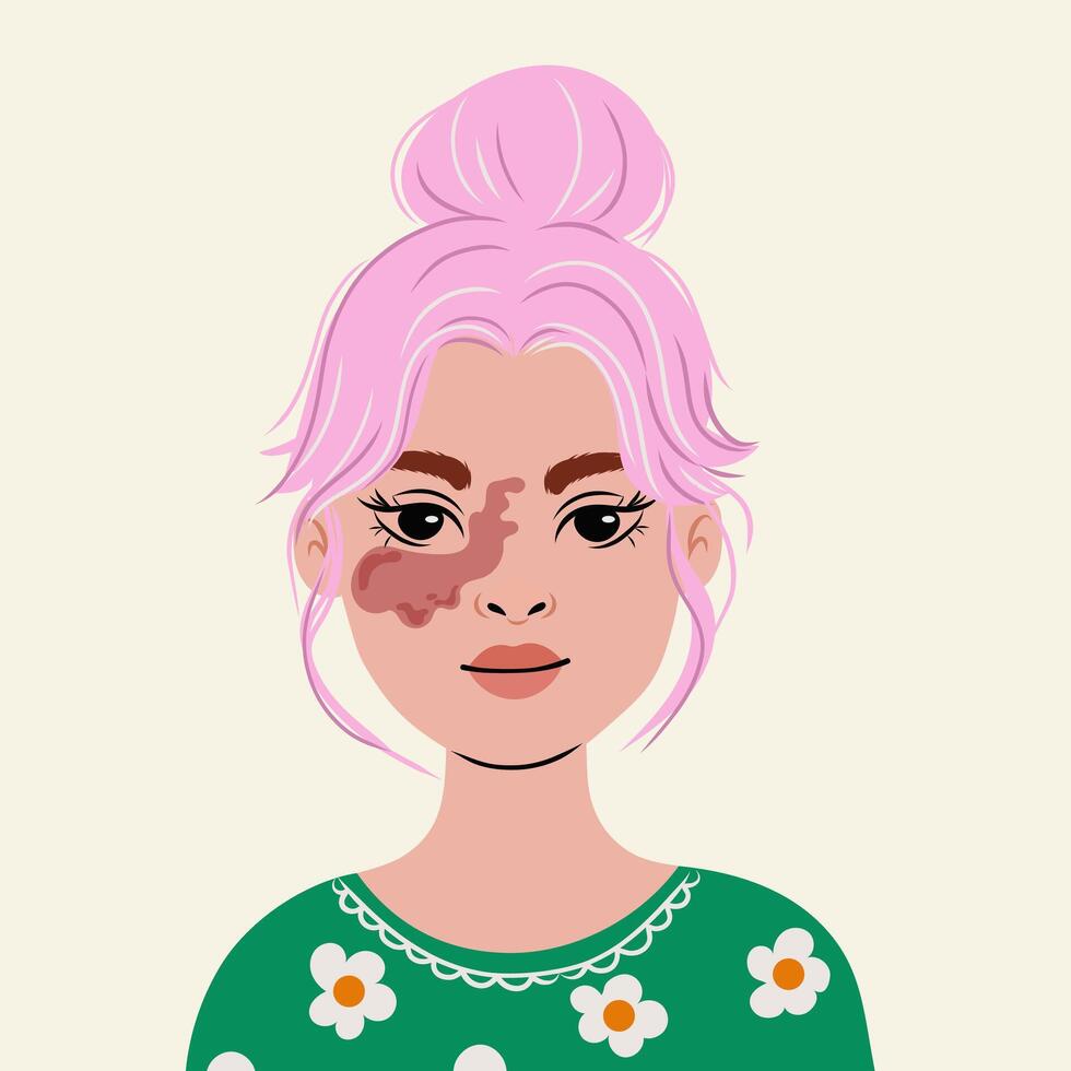 Port wine stain on the face of the child and adult .Diverse beauty , young woman with Birthmark on face , hand drawn flat illustration isolate on white . vector