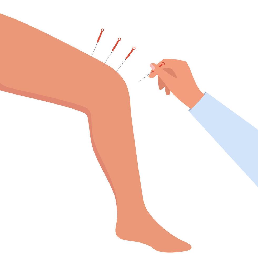 Acupuncture Therapy in Spa Salon. Hand Injects Needles in human leg. Chinese needle alternative medicine and treatment. Illustration. vector