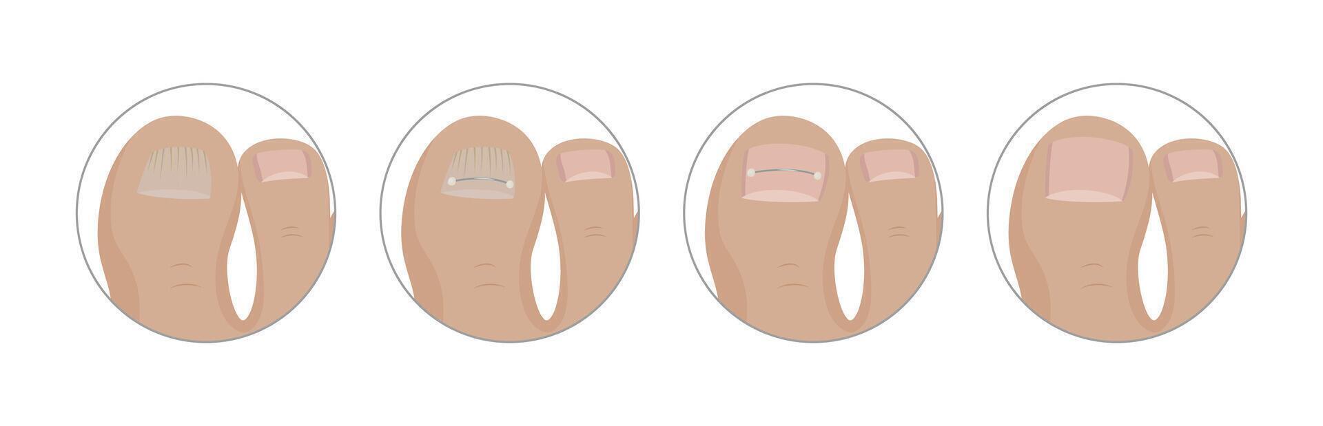 Correcting ingrown toenail with titanium thread, podiatrist performs step by step medical procedure aimed at alleviating pain and restoring healthy nail growth vector