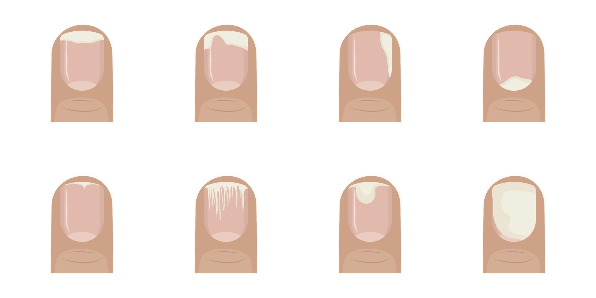 Onycholysis patterns are depicted, showing various stages and forms of nail separation from the nail bed, providing a visual guide for identifying nail disorders vector