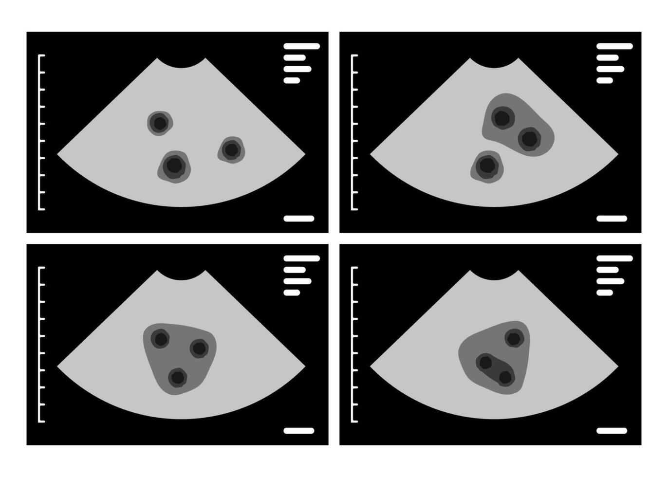 Four ultrasound images capturing three fetuses developing during pregnancy, illustrating a remarkable case of triplets growing inside the womb, highlighting the miracle of life vector