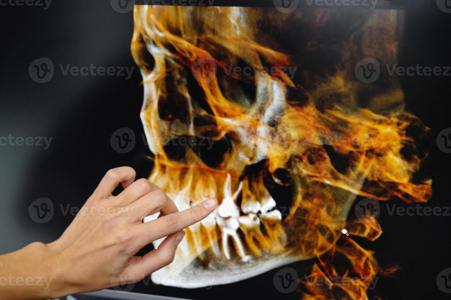 The dentist shows the patient his x-ray of the jaw. Panoramic shot of teeth on the screen at dentist. photo