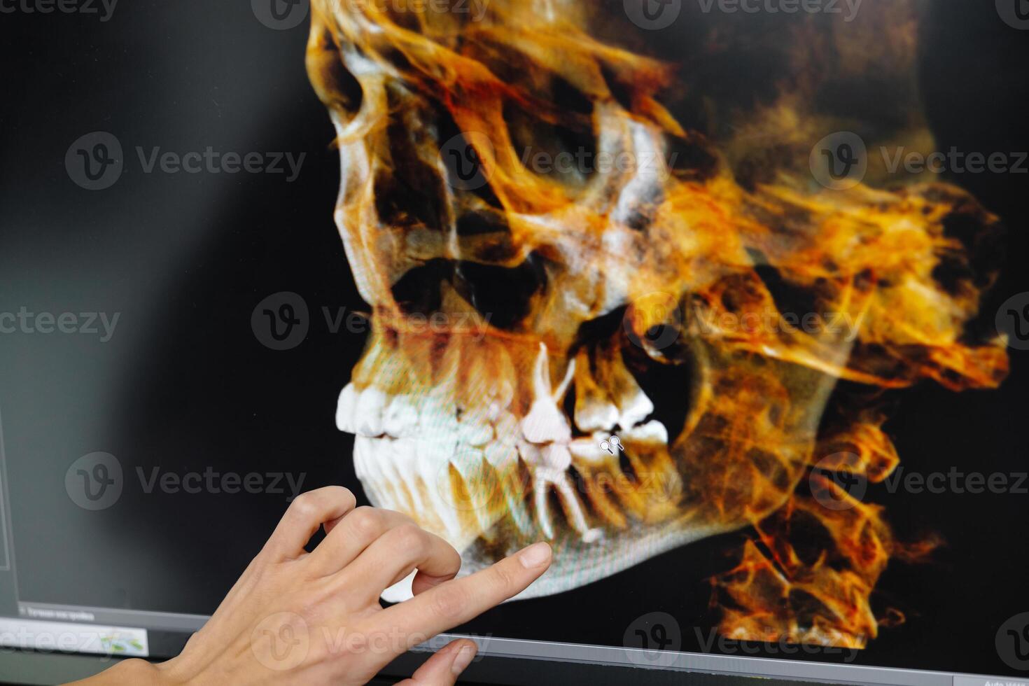 The dentist shows the patient his x-ray of the jaw. Panoramic shot of teeth on the screen at dentist photo
