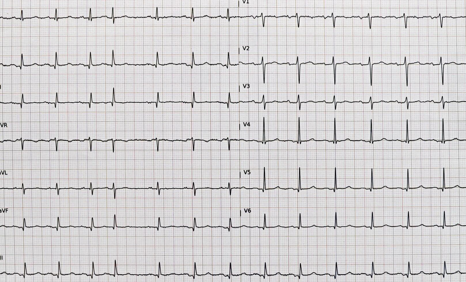 Detailed EKG, electrocardiogram photo