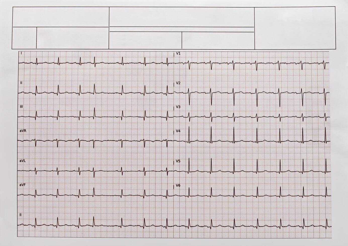 Detailed EKG, ECG, electrocardiogram showing heartbeat patterns. photo