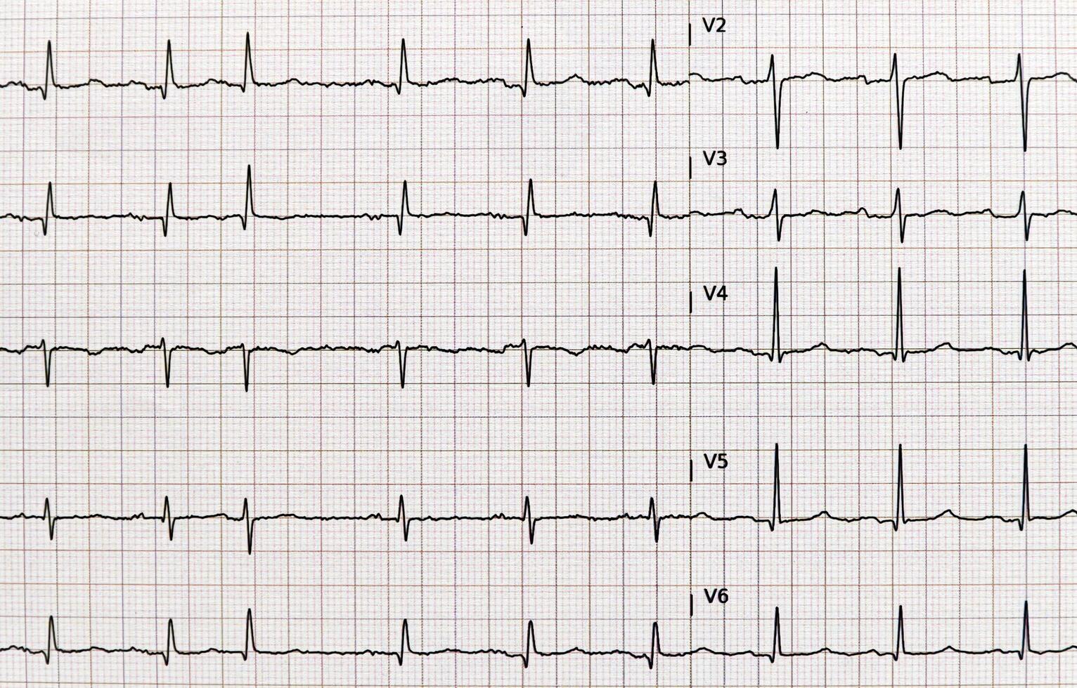 Detailed EKG, electrocardiogram showing heartbeat photo
