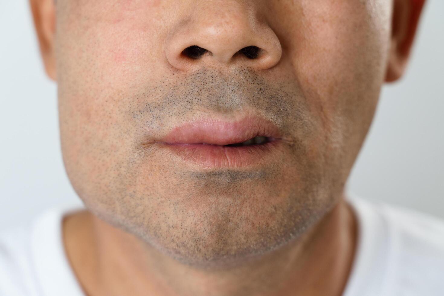 The man has facial swelling due to an allergic reaction to triggers such as insect bites stings.11 photo