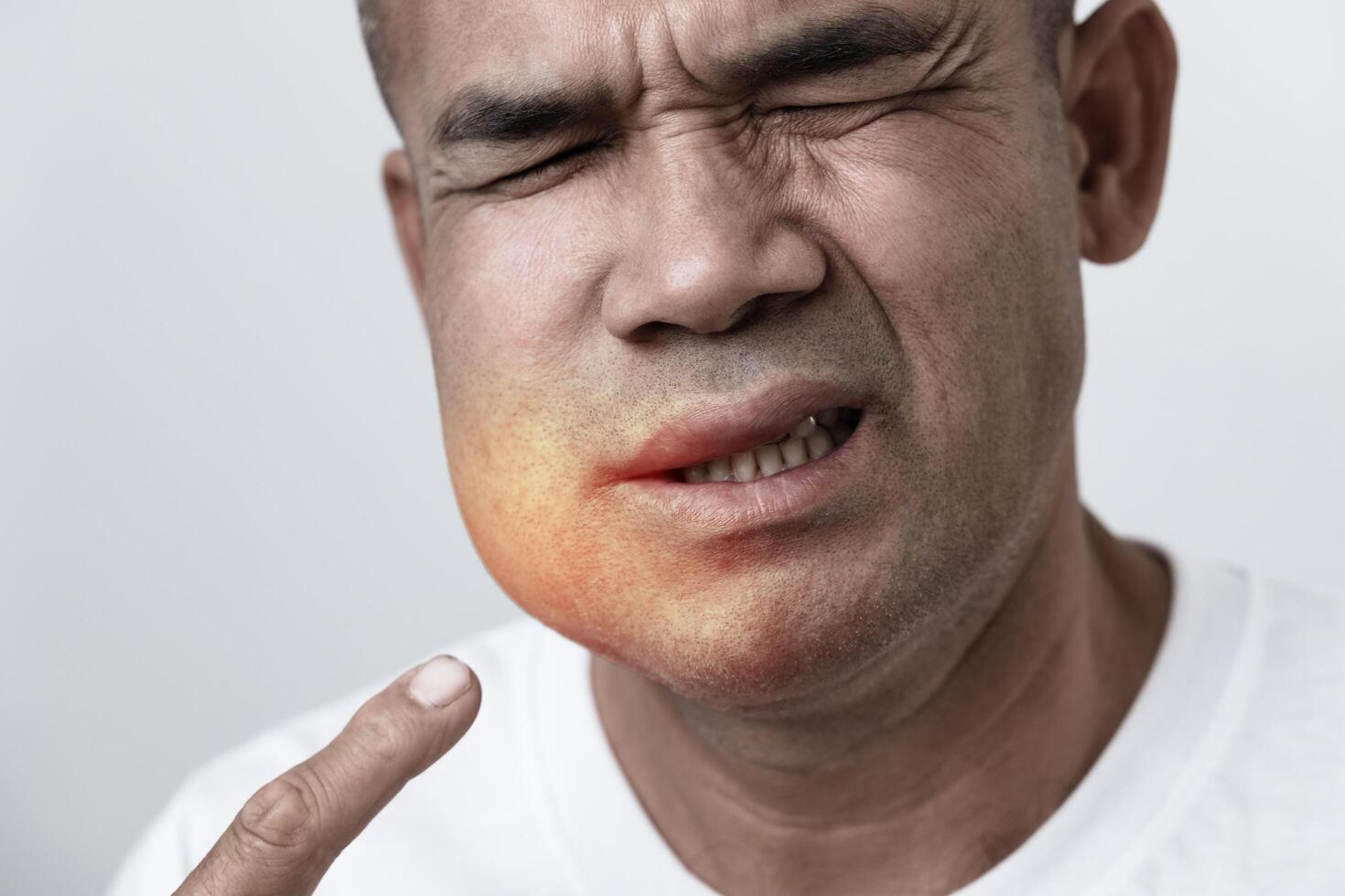 The man has facial swelling due to an allergic reaction to triggers such as insect bites stings.7 photo