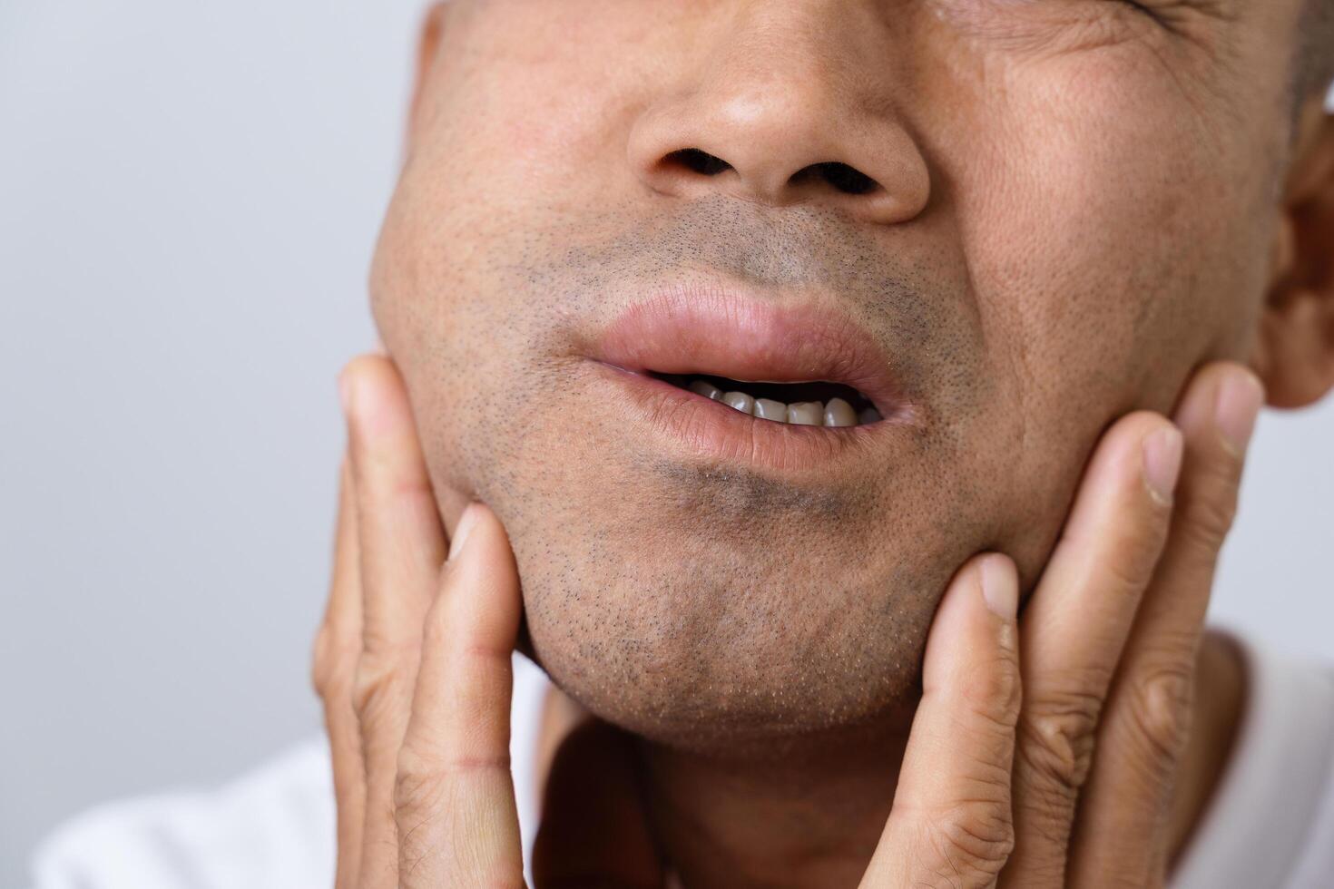 The man has facial swelling due to an allergic reaction to triggers such as insect bites stings.1 photo