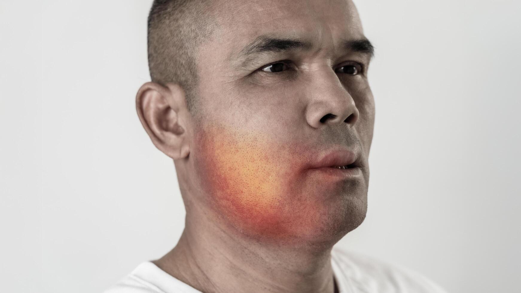 The man has facial swelling due to an allergic reaction to triggers such as insect bites stings.4 photo