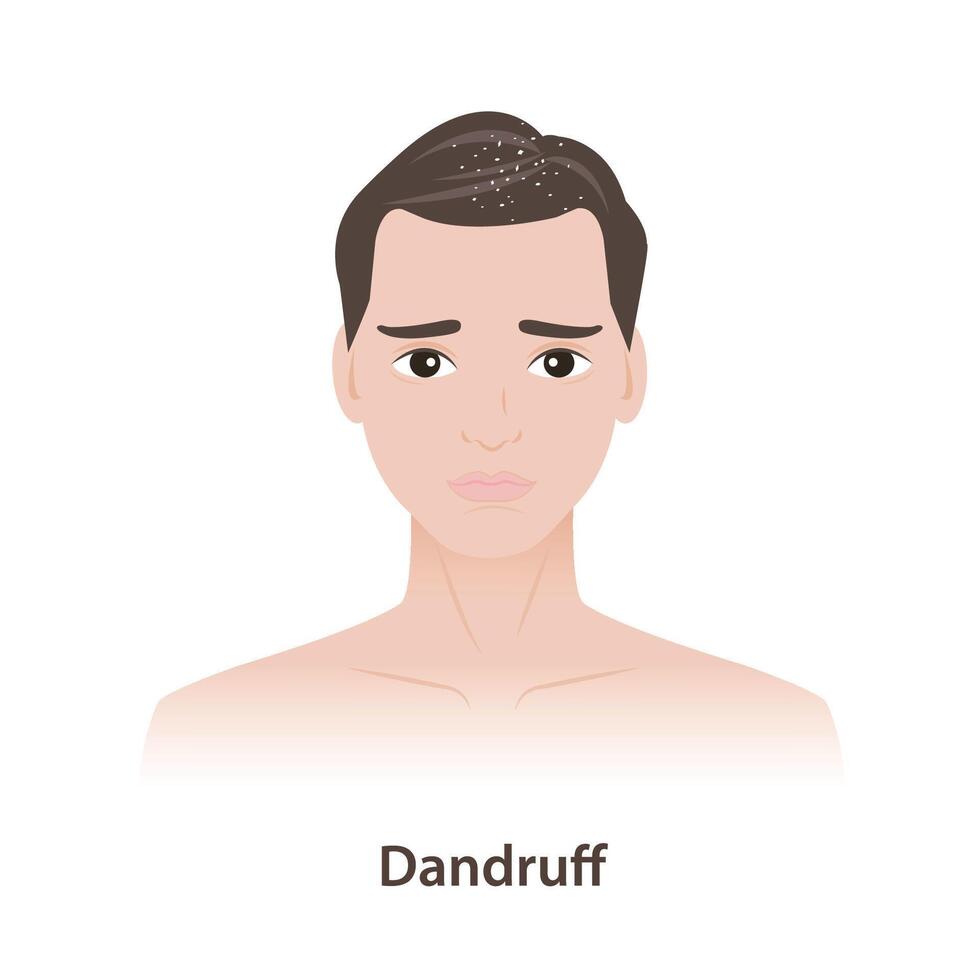 The man with dandruff in hair illustration. Dandruff is the skin on the scalp to dry flaky, itchy, white, yellowish flakes in hair, on shoulders. Scalp irritation, mild form of seborrheic dermatitis. vector