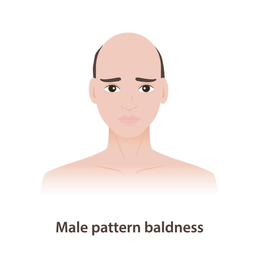 Male pattern baldness is hair problems for men illustration on white background. Androgenetic alopecia is a type of hair loss, often stemming from genetics and hormone dihydrotestosterone, DHT. vector