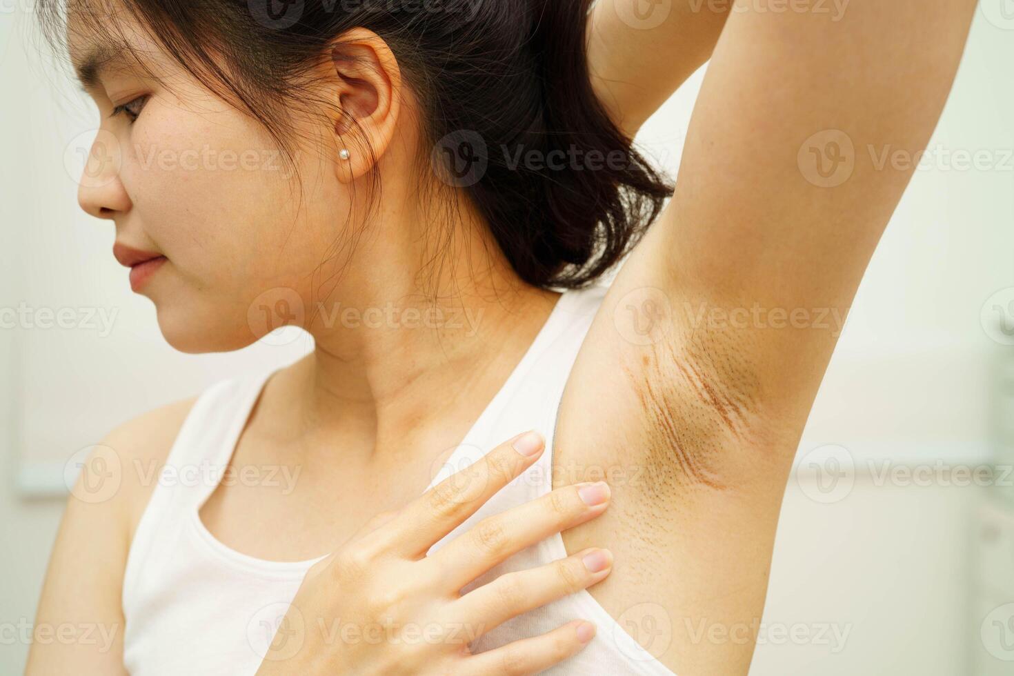 Asian woman have problem black armpit beauty photo