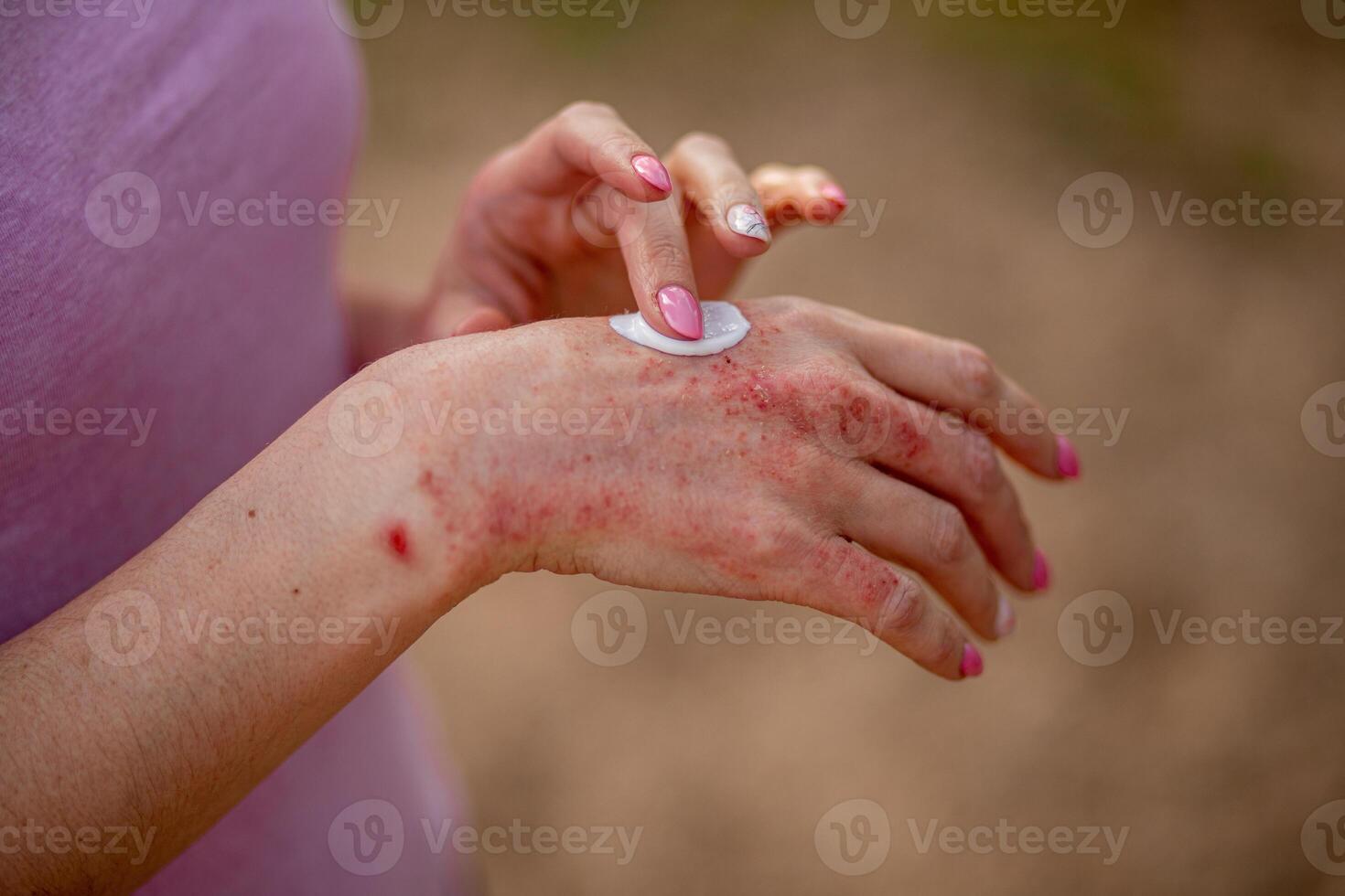 Eczema on the hands. The woman applying the ointment , creams in the treatment of eczema, psoriasis and other skin diseases. Skin problem concept photo