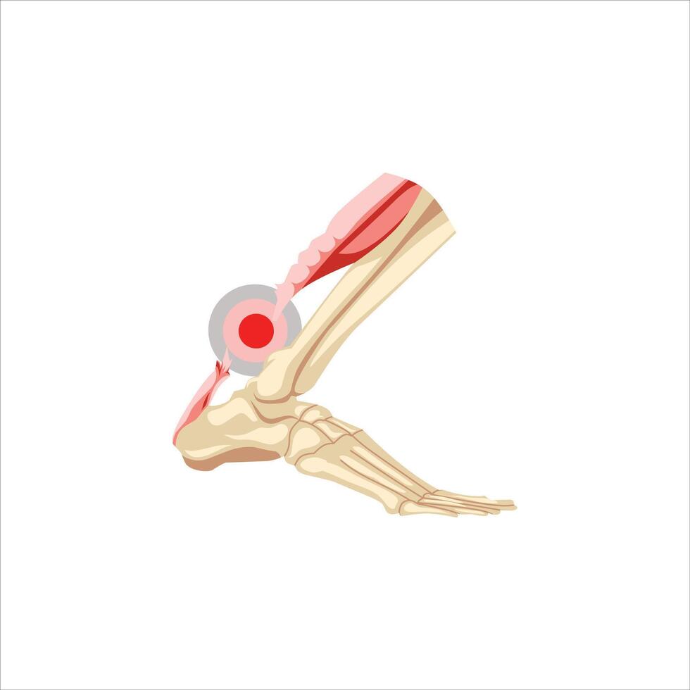 An anatomical illustration shows the lower leg's skeletal structure and Achilles tendon, Achilles tendon rupture foot injury concept simple concept vector
