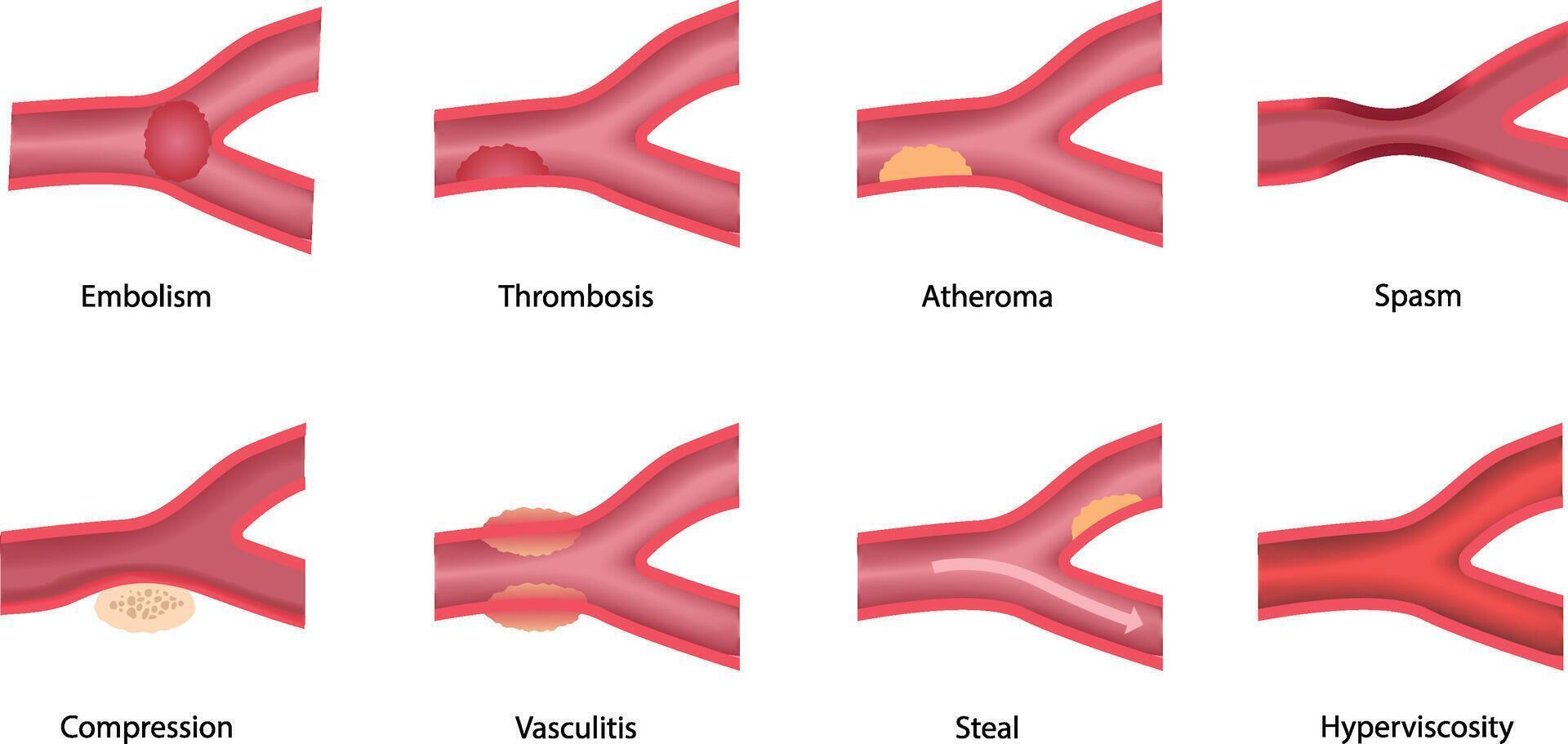 illustration of vascular flow disruptions vector