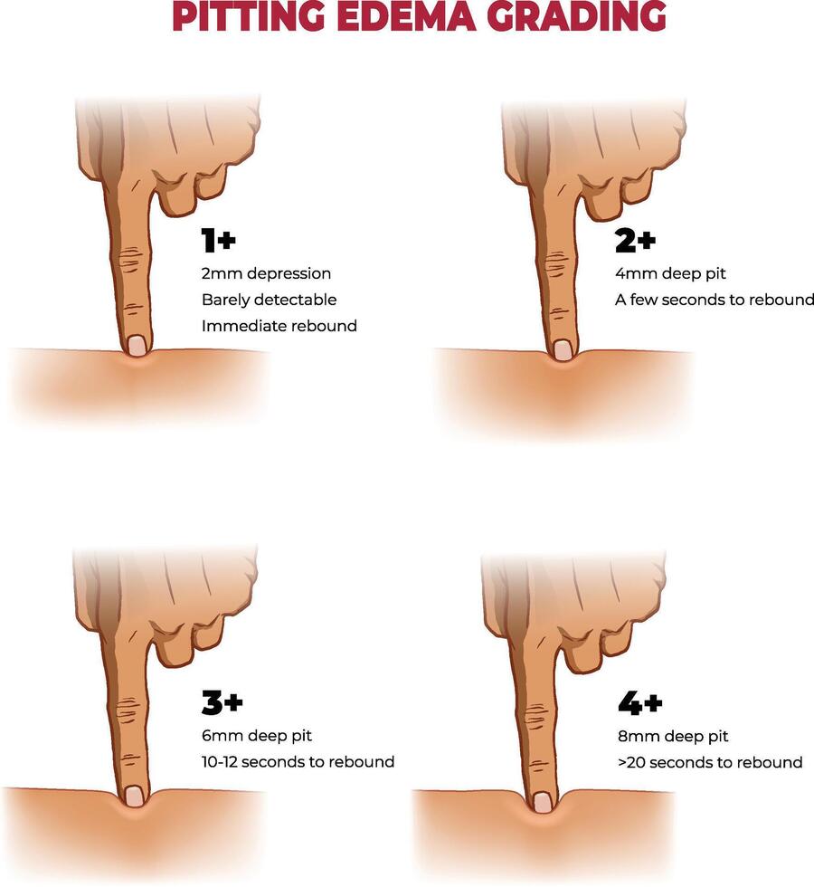 illustration of pitting edema grading infographic vector