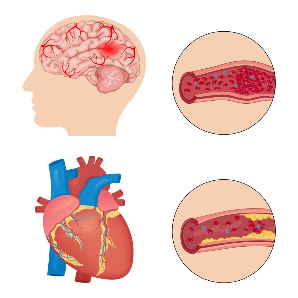 cerebrovascular accident, stroke, or cerebral infarction with a thrombus or blood clot. Atherosclerosis concept, health risk. Human heart. vector