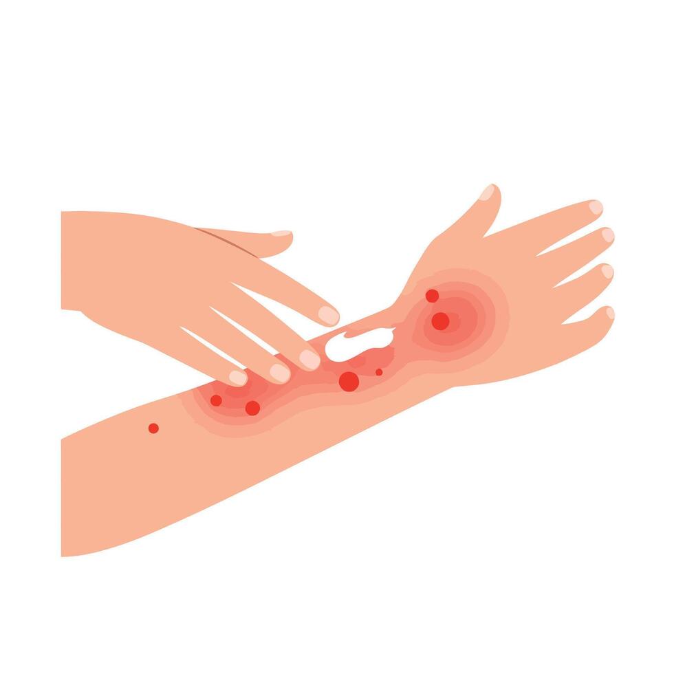 Skin irritation depicted in flat art showing before and after treatment stages vector