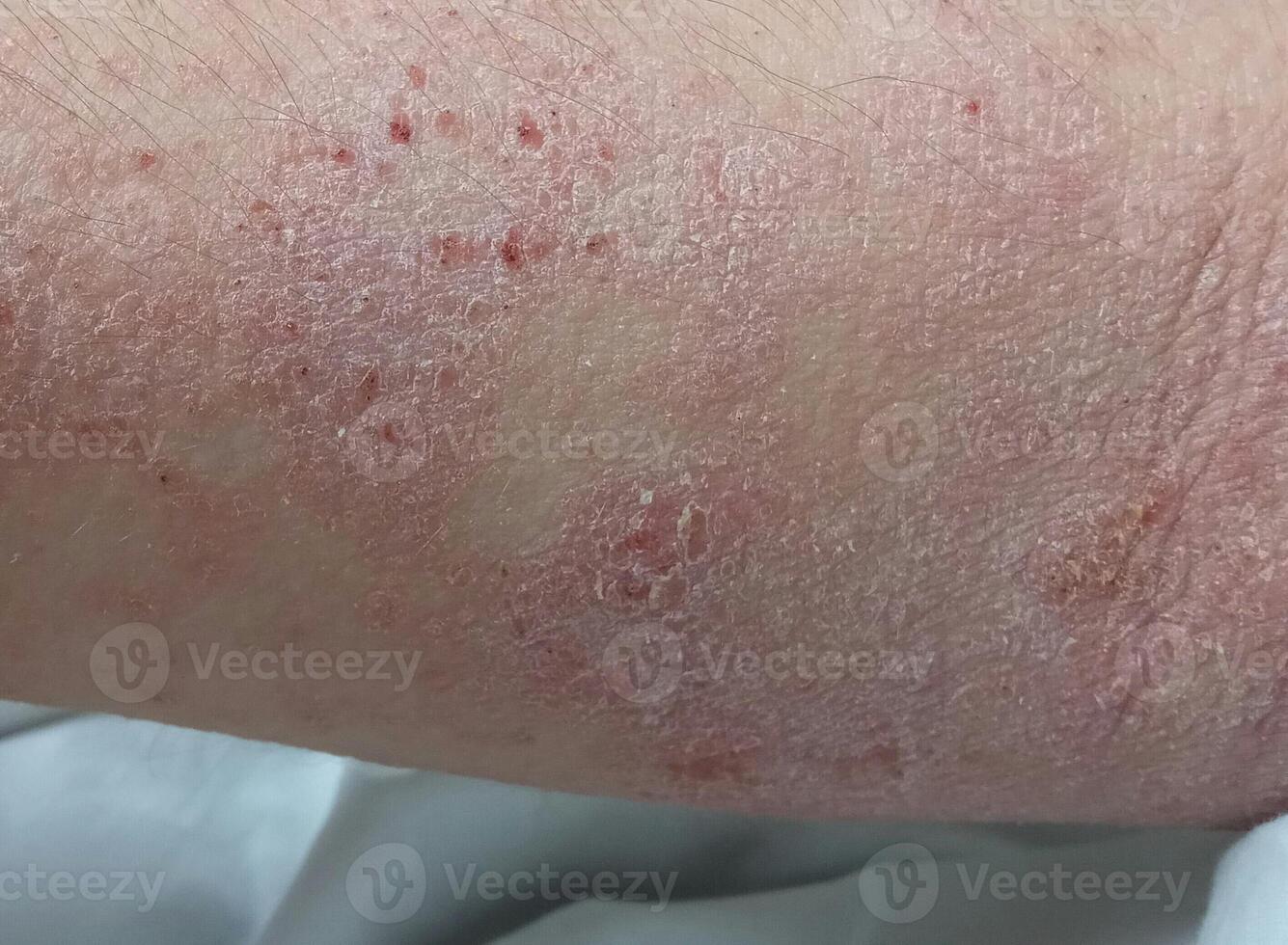 Close-up eczema atopic dermatitis symptom with infected skin photo