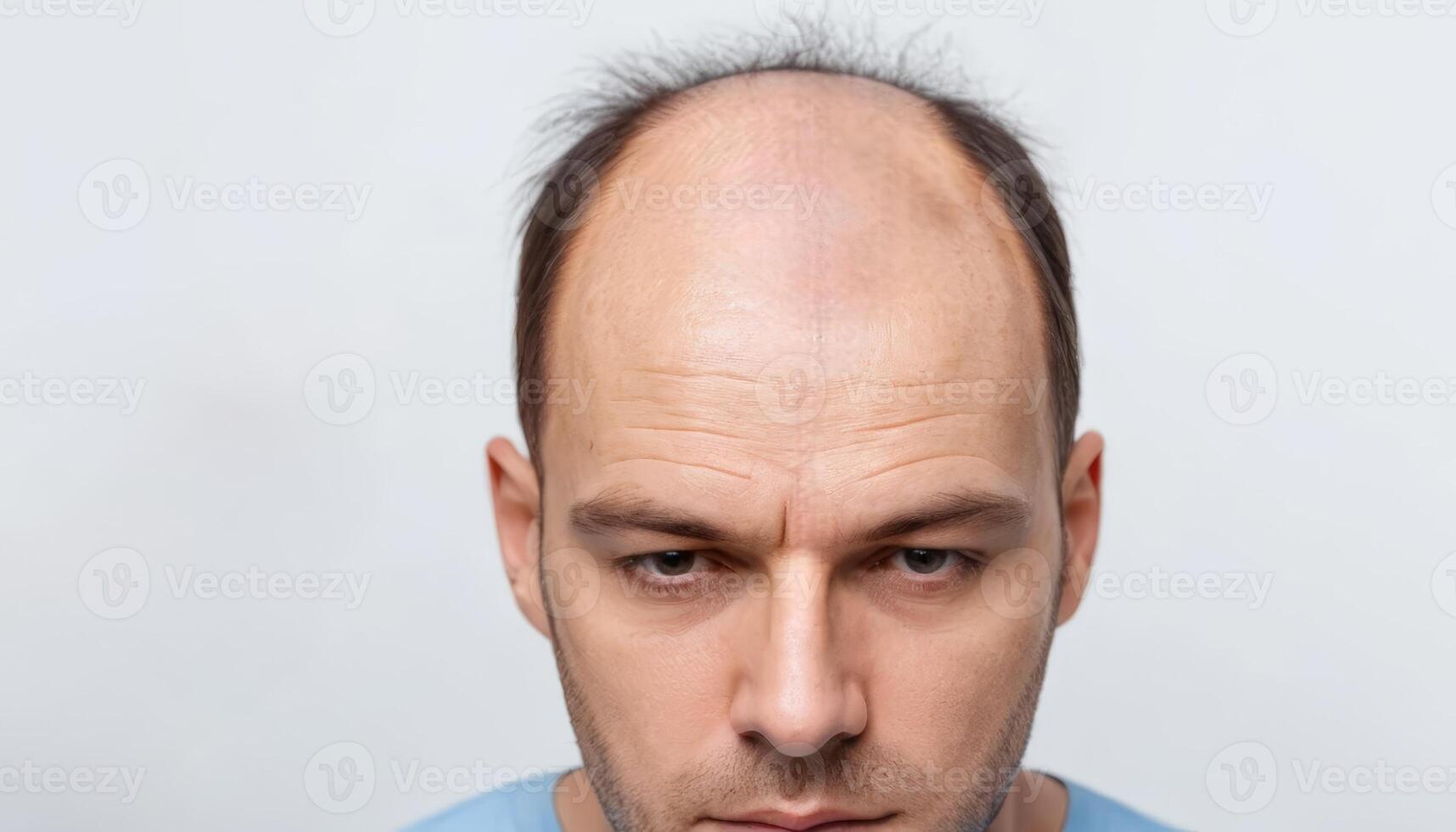 A man with a receding hairline and thinning hair looks directly at the camera, highlighting concerns about hair loss and its emotional impact. photo