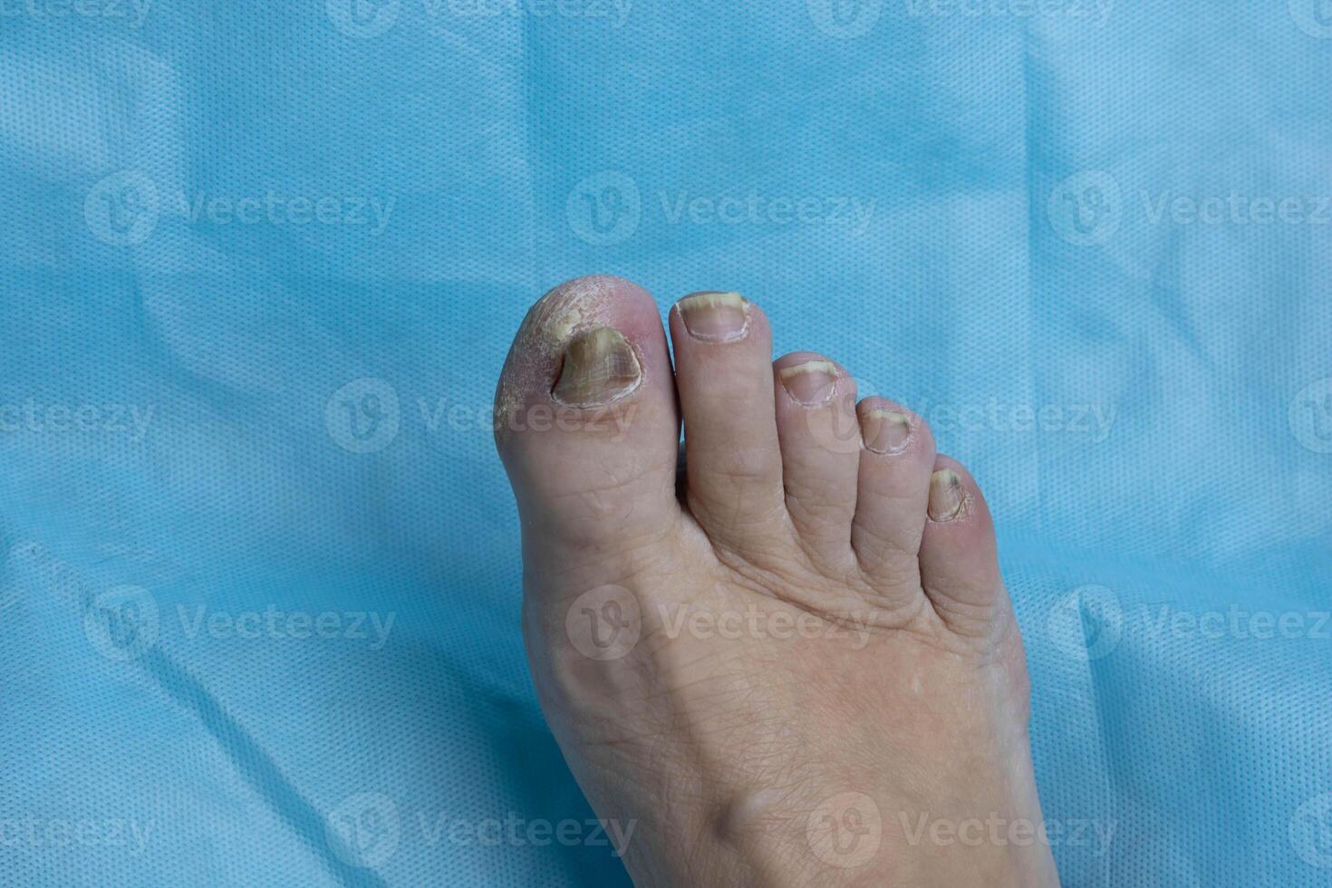 One female foot with a fungal nail infection, with thick, crumbly toenails. photo