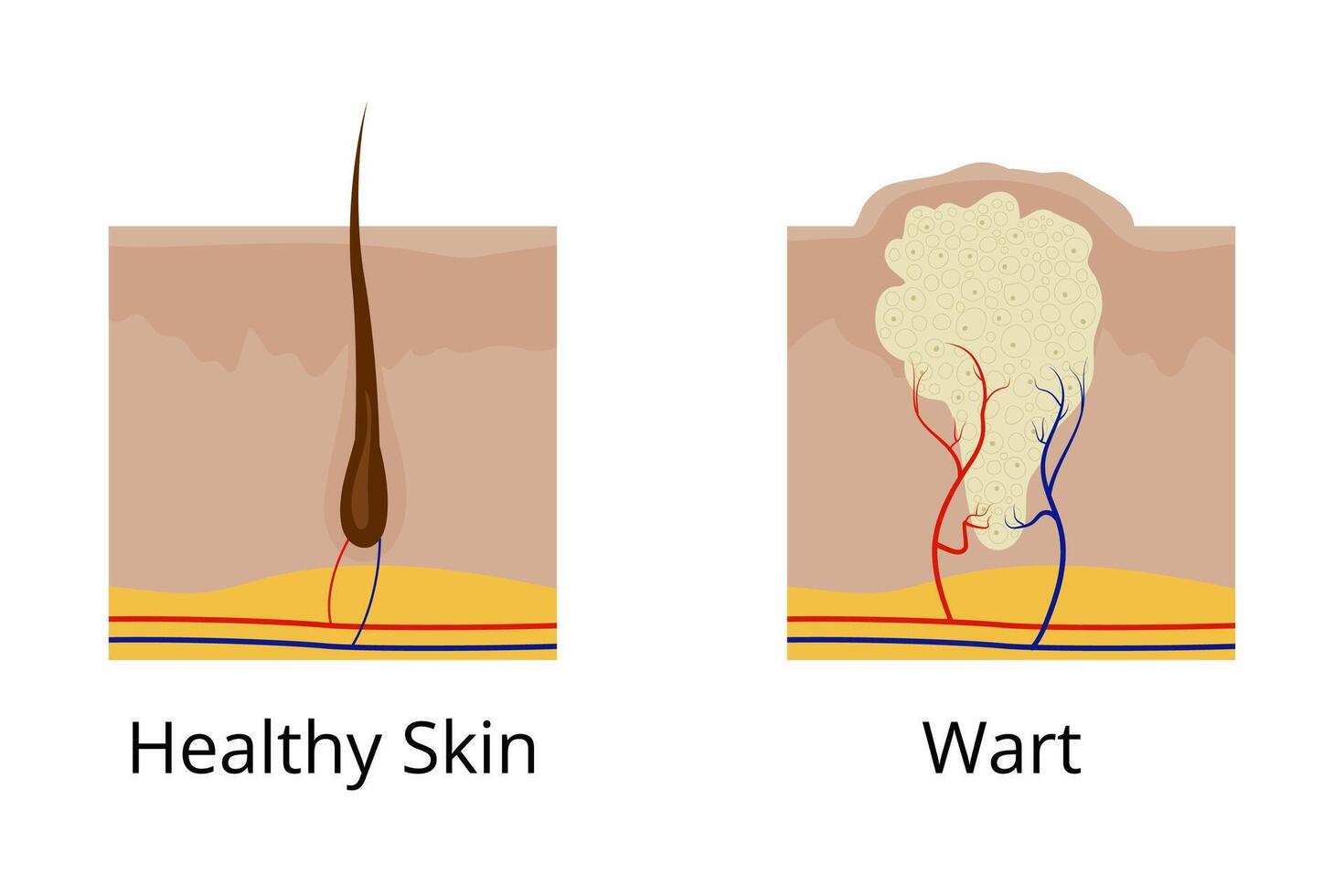 Healthy skin and wart comparison showing arteries and veins vector