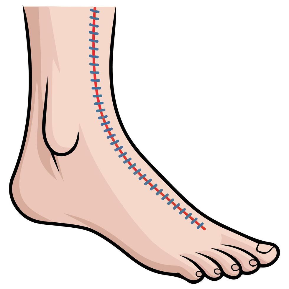 leg wound with surgical thread isolated illustration on white background vector