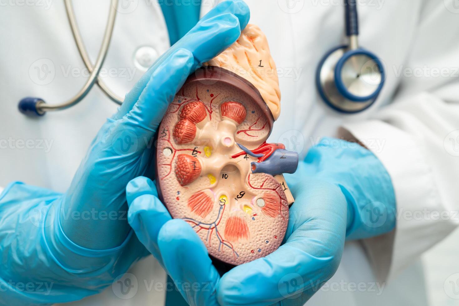Kidney disease, Chronic kidney disease photo
