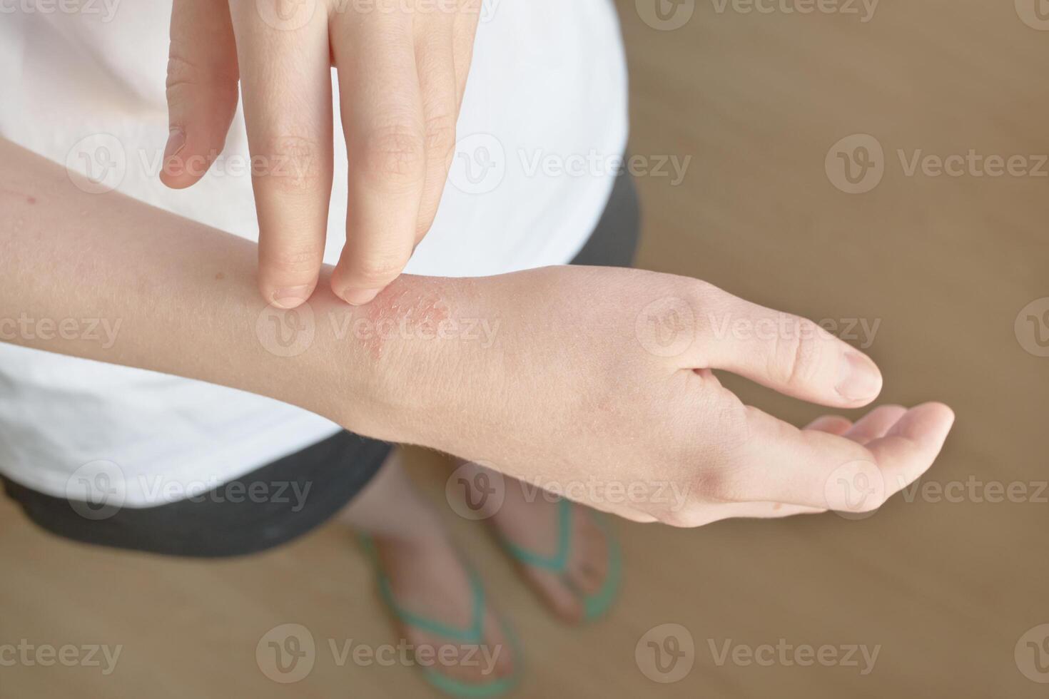 Managing eczema. close-up of skin condition and treatment concepts photo