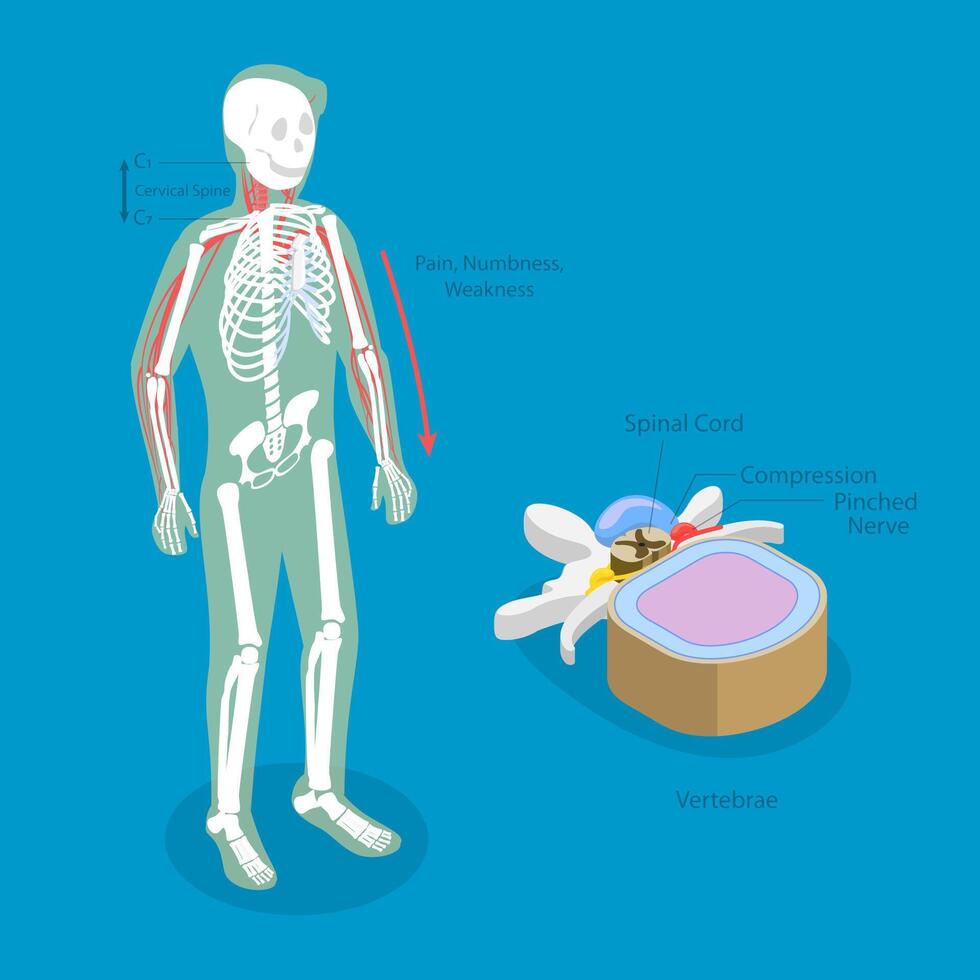 3D Isometric Flat Illustration of Cervical Radiulopathy, Traumatic Spinal Cord Injury with Painful Pinched Nerves vector
