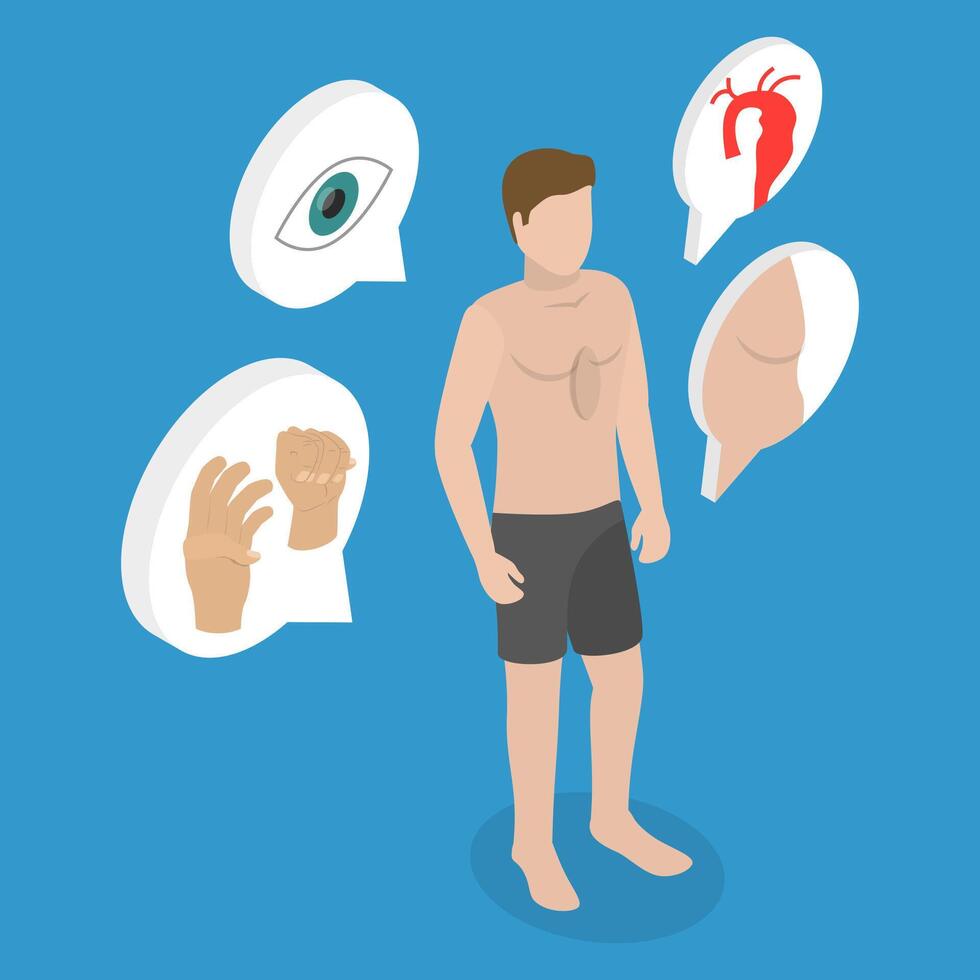 3D Isometric Flat Illustration of Marfan Syndrome, Dwarfism vector