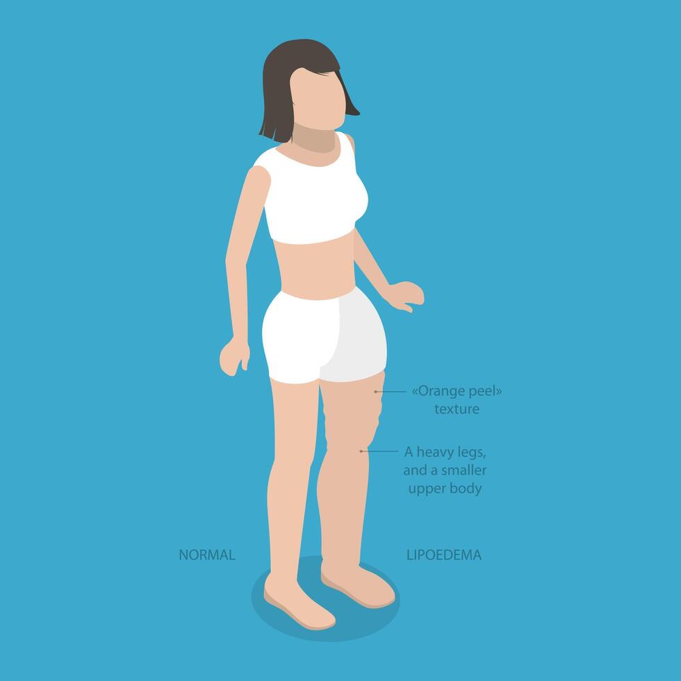 3D Isometric Flat Illustration of Lipoedema, Overweight Issues vector