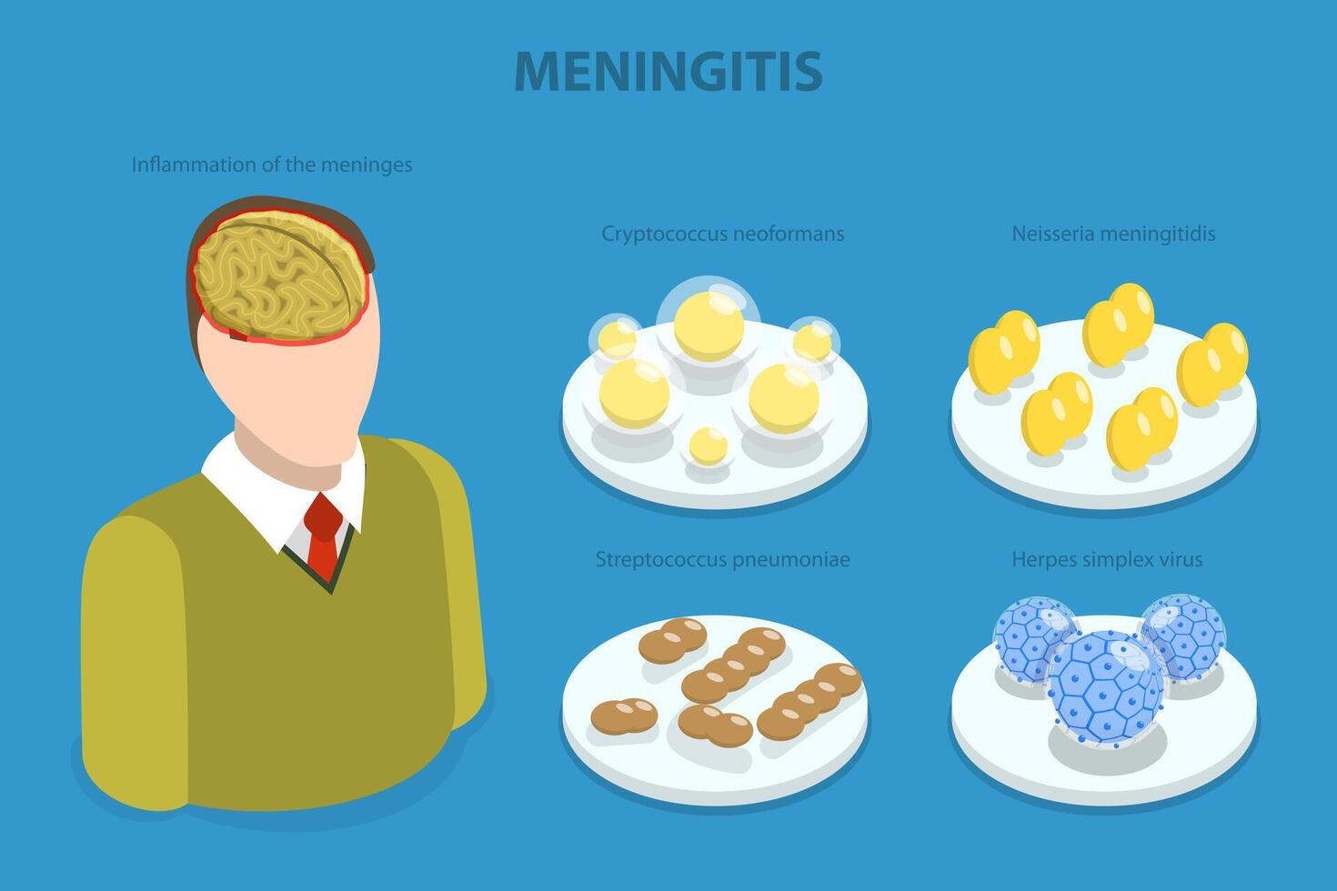 3D Isometric Flat Illustration of Meningitis, Meningococcal Disease, Dangerous Meninges Inflammation vector