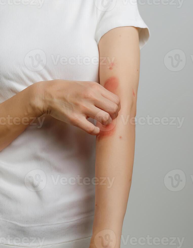 Close-up of irritated skin being scratched by a fair-skinned hand, showing symptoms of skin sensitivity or dermatitis photo