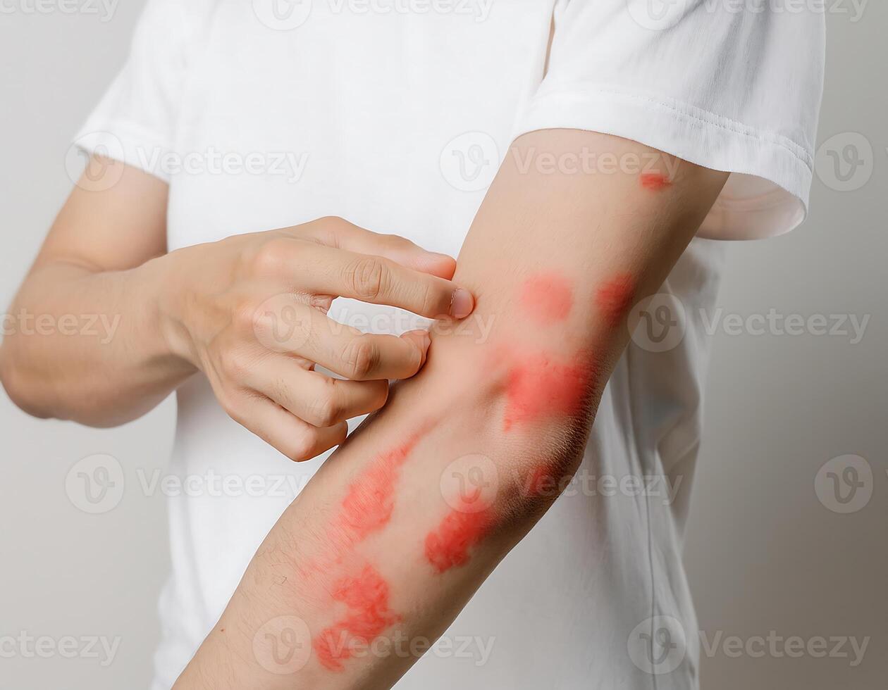 A person in a white t-shirt experiencing an itchy red rash, highlighting common skin conditions like allergies or dryness photo