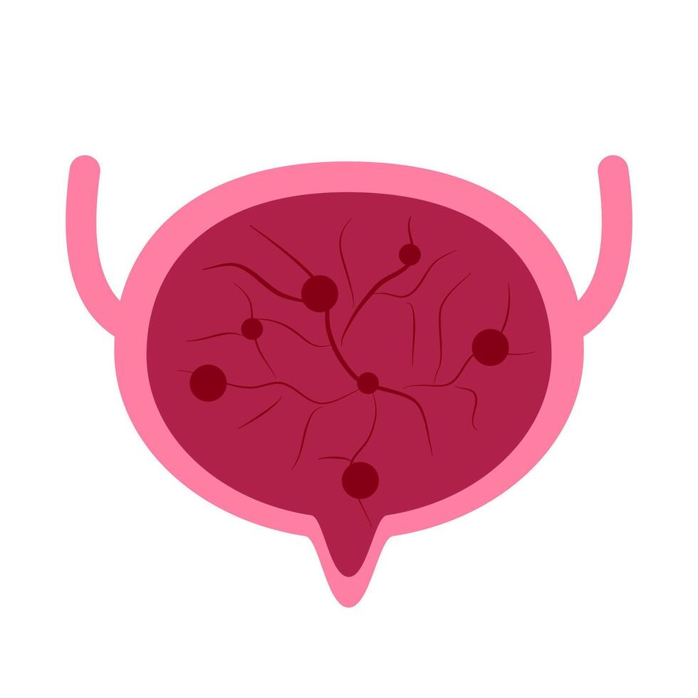 Inflammation Bladder illustration vector