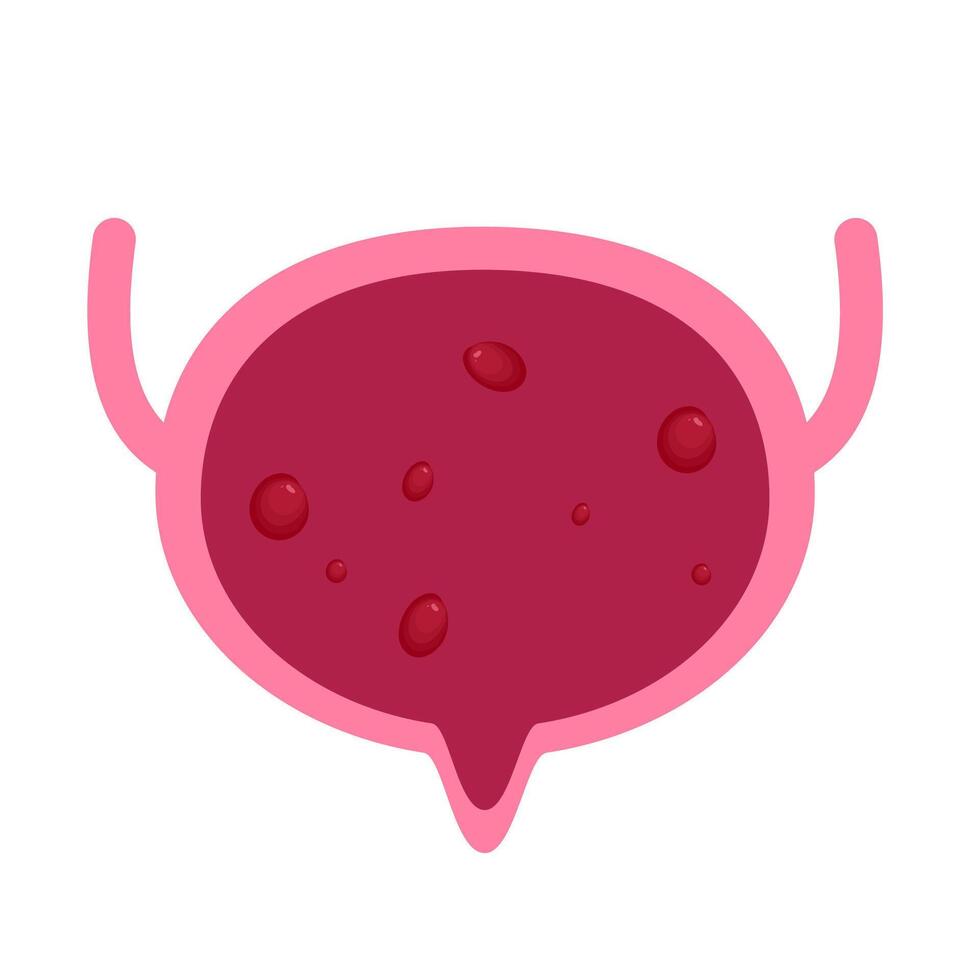 Bladder polyps illustration vector