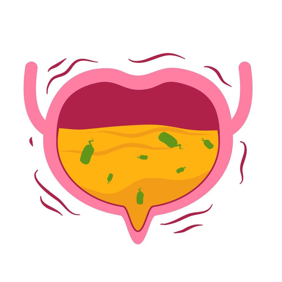 Urinary tract infection illustration. Bladder infection. vector