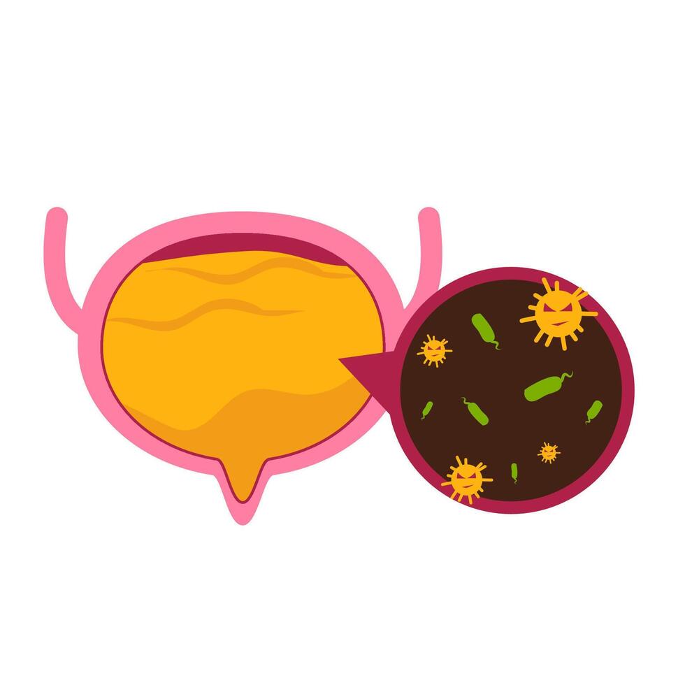 Urinary tract infection illustration. Bladder disease. vector