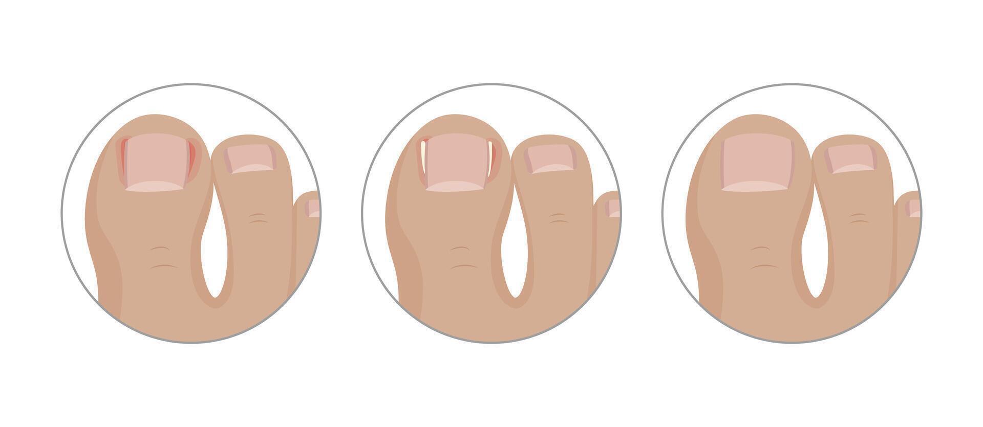 Ingrown toenail surgery using a tamponade, three steps of healing process vector