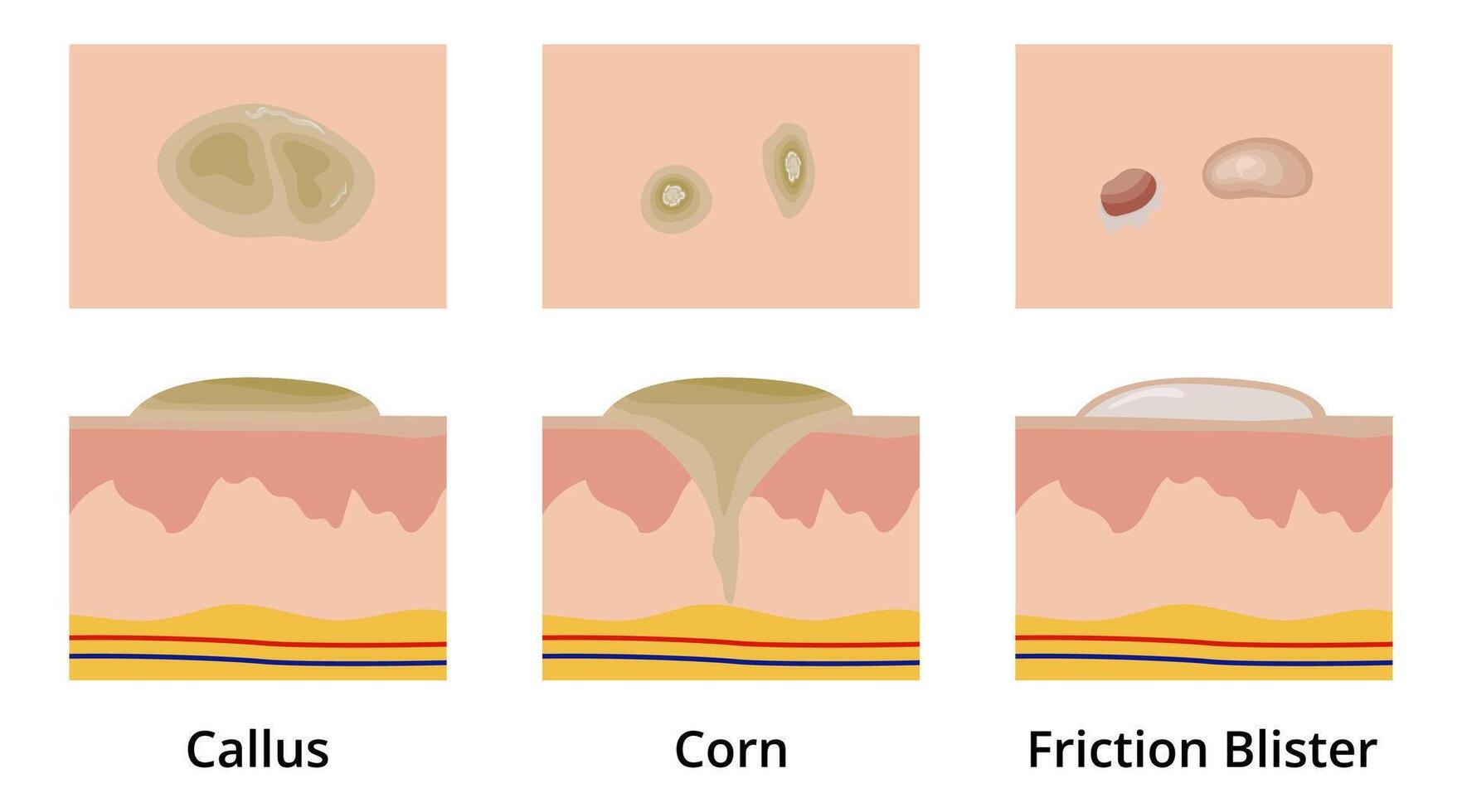 Callus, Corn and Friction Blister on Human Skin Cross Section vector